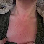 Before and after appearance of turkey neck and crepey neck skin improvement